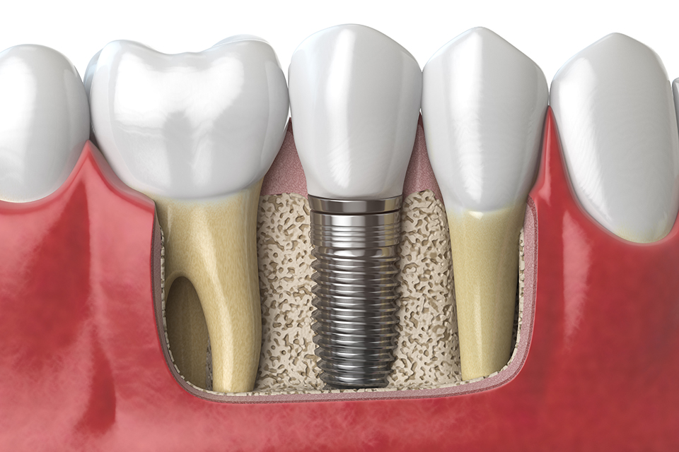 Richmond dentist Implants